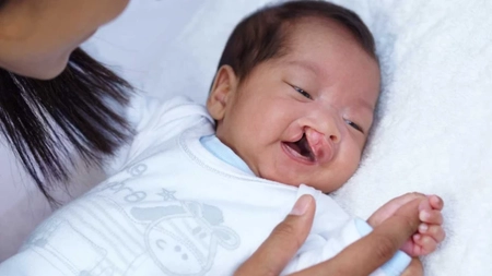 Ce este gura de lup? Care sunt simptomele și cauzele afecțiunii? Iată cum poți trata boala palatoschizis!