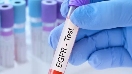 Ce înseamnă faptul că ai rata filtrării glomerurale scăzută? Iată ce opțiuni de tratament există