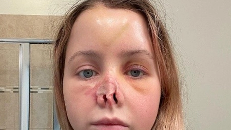 A avut nevoie de zeci de operații estetice pentru a-și recupera înfățișarea. O femeie a rămas fără nas după ce a fost atacată de un câine