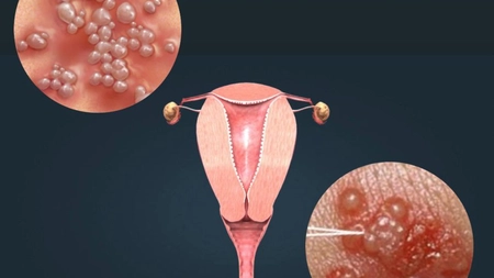 Iată care este tratamentul herpesului genital la femei! Informații esențiale pentru înțelegerea și gestionarea afecțiunii