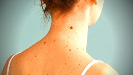 Vrei să știi ce se întâmplă dacă îți rupi o aluniță? Mituri vs. realitate!