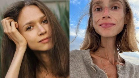 Karolina, o tânăra de 27 de ani, a murit cântărind doar 22 de kilograme. Ce dietă a urmat