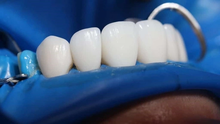 Dinți de zirconiu. Iată de ce este apreciat acest material pentru refacerea danturii