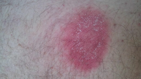 Ce este un eritem migrator? Primul semn al bolii Lyme, confundat adesea cu o simplă răceală!