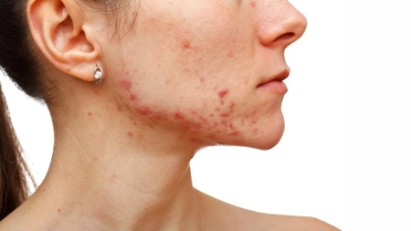 Leacuri bătrânești pentru coșuri. Iată ce remedii naturale pot fi folosite pentru acnee