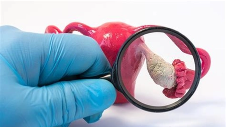 Ce presupune schema de tratament pentru un chist ovarian? Iată tot ce trebuie să știi despre această afecțiune medicală