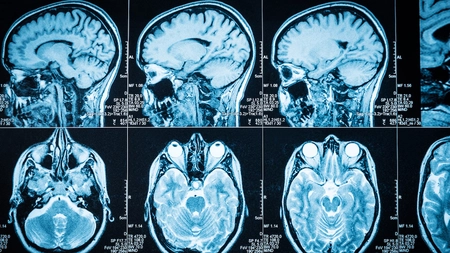Cum se manifestă o atrofie cerebrală și cerebeloasă difuză? Iată câteva informații esențiale pentru înțelegerea afecțiunii!