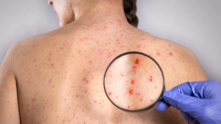 De ce apar bube pe corp cu mâncărime? Iată ce afecțiuni pot ascunde și cum se tratează!