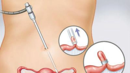 Legarea trompelor. Cea mai sigură metodă de contracepție! Află ce presupune procedura și cui i se adresează!