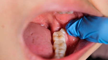 Ce preț are o extracție de măsea? Iată ce trebuie să faci imediat după procedură!