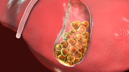 Cum se formează piatra la colecist? Dr. Radu Marian explică ce este, cum se tratează și cum poate fi prevenită!