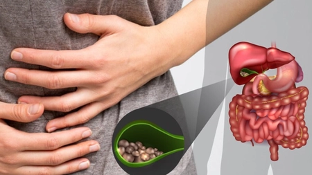 Ce simptome dau pietrele la colecist și când se recomandă operația? Iată ce trebuie să știi!