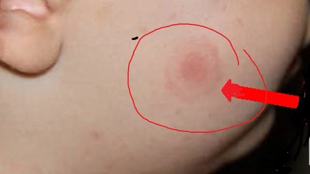 Doctorul Tudor Ciuhodaru: Ce trebuie să știți (să faceți) în cazul mușcăturilor de căpușe