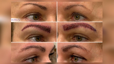 Look bine definit: ce preț are implantul de sprâncene la Dr. Felix Hair Implant în București?