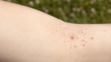 Cele mai bune tratamente naturale pentru Molluscum contagiosum