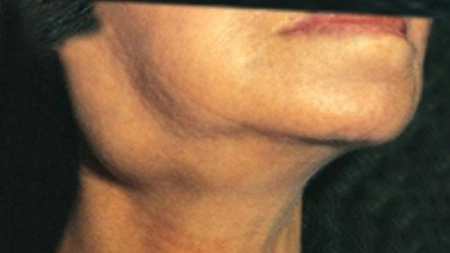 Ganglionii inflamati. Vezi care sunt posibilele cauze, in functie de pozitia ganglionului