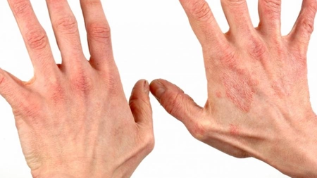 Otetul de <em class='ep-highlight'>mere</em> face minuni pentru bolnavii de psoriazis
