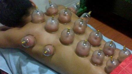 Avantajele si dezavantajele terapiei cu ventuze