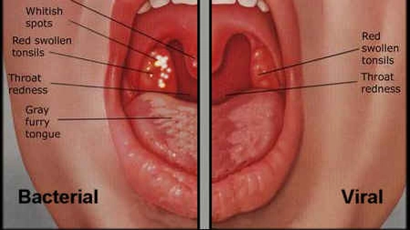 Alimente interzise si permise in caz de amigdalita
