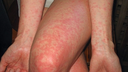 Urticaria care iti strica concediul la mare