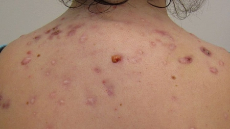 Sfatul dermatologului: Cum scapi de acneea de pe corp