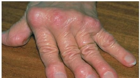 Primele semne ca o persoana sufera de guta