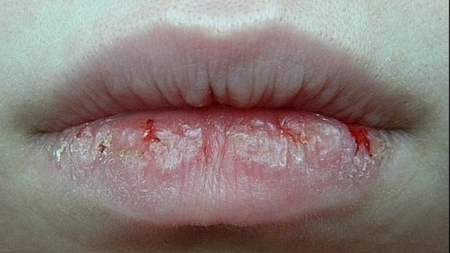 Remedii pentru buze uscate si crapate