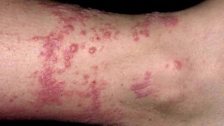 Dermatoza de contact. Cauze, simptome si tratament