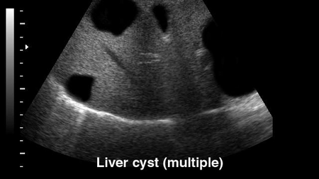 Cum sa folosesti patrunjelul pentru a scapa de chisturile la rinichi si ficat