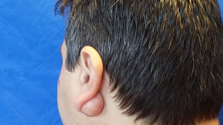 Cand sa ne igrijoreze umflaturile de dupa ureche