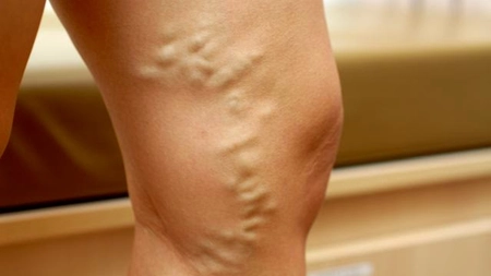 Reteta cu otet de mere pentru tratamentul varicelor
