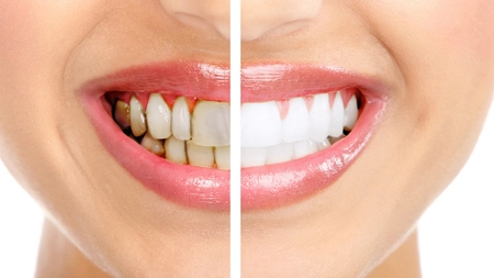 Cum se trateaza parodontoza, boala care ne lasa fara dinti