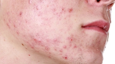 Acneea hormonala - cauze/preventie