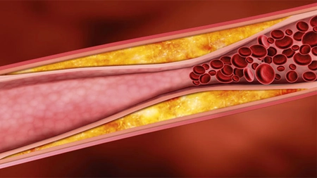 Tratamente naturiste pentru indepartarea placii de aterom din artere