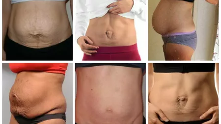 Diastaza abdominala, problema multor femei care au nascut. Cum o recunosti