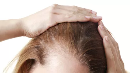 Alopecia: cand căderea părului devine o boala grava