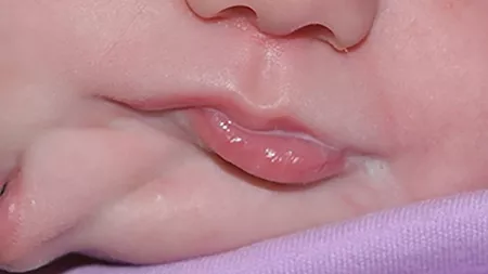 Copilul nascut cu doua guri