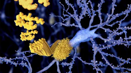Boala Alzheimer: rezultate promițătoare pentru un test de sânge de detecție timpurie