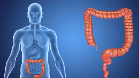 10 sfaturi alimentare pentru intestinul iritabil