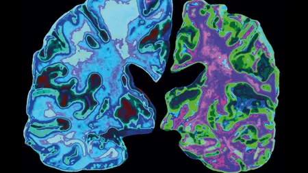 Alzheimer: ce rol joaca dimensiunea taliei
