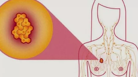 Cercetătorii au descoperit cum să încetinească creșterea celulelor de cancer mamar