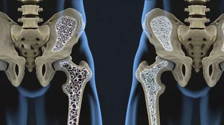 Osteoporoza: cei 3 nutrienti esentiali pentru oase puternice
