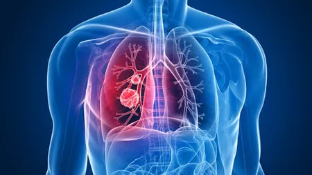 Cancer pulmonar: 13 simptome pe care nu ar trebui să le ignorați
