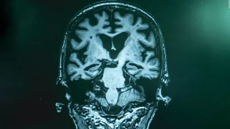 Boala Alzheimer nu începe întotdeauna cu pierderi de memorie: amnezia nu este neaparat un simptom clar