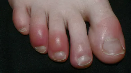 Degetele albastre, un simptom al Covid-19 persistent
