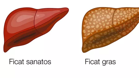 Ce regim trebuie să urmezi dacă ai ficat gras? Alimente permise