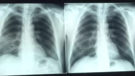 COVID-19: leziuni pulmonare prezente mult timp după infectare, arată un studiu al Universitatii Oxford