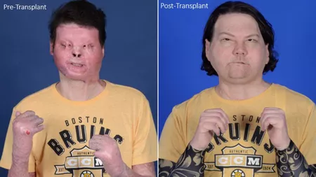 A fost realizat primul transplant de față și mâini din lume! Cum se simte pacientul