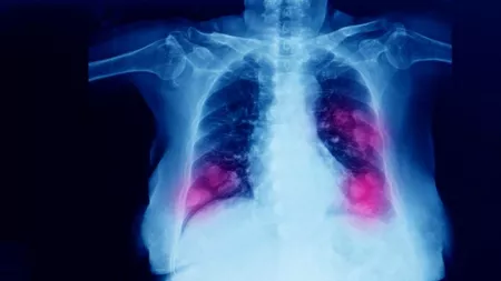 Covid lung: unul din trei pacienți ar fi afectat de simptome pe termen lung, după spitalizare