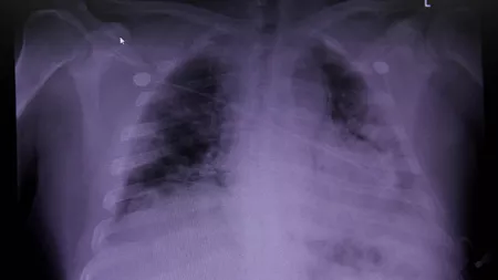 Covid lung: pacientii ar avea un risc crescut de deces in decurs de 6 luni